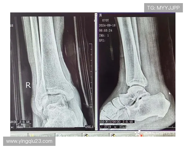 踝关节骨折影响职业生涯的足球明星们的奋斗与复苏故事